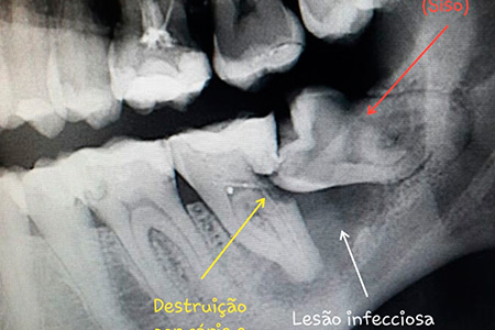 Cirurgia Oral Menor