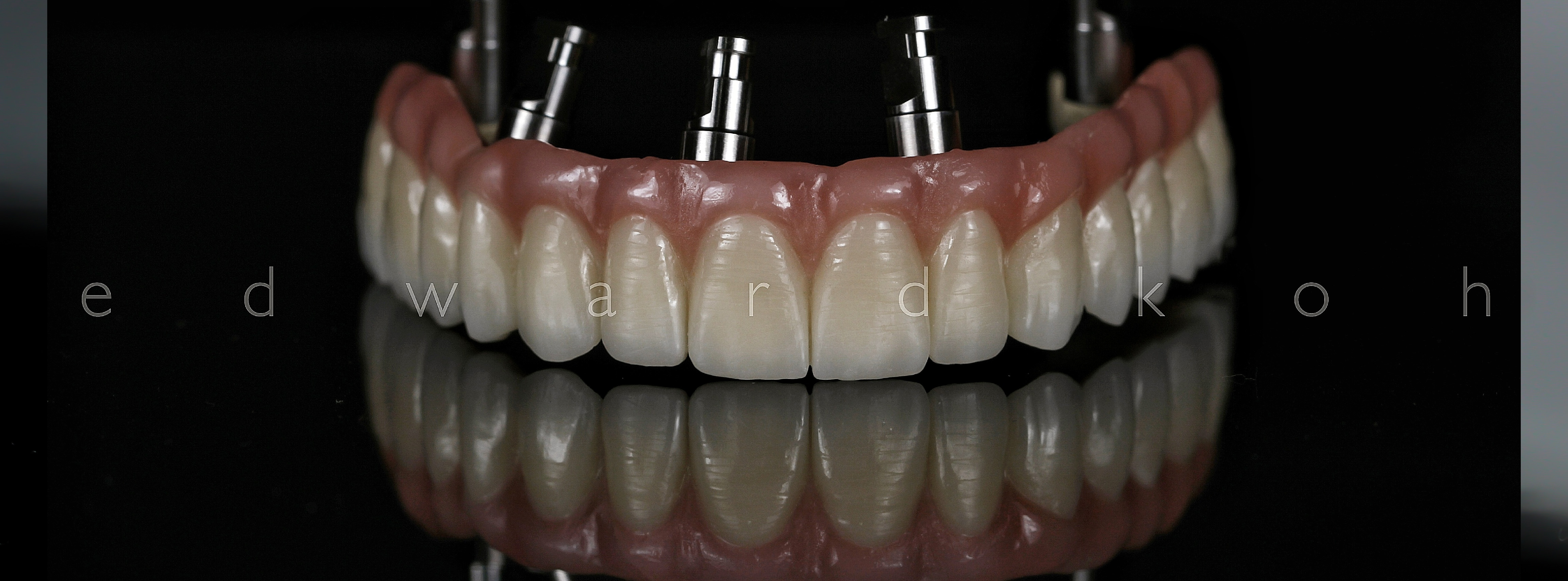 Implantes Dentários