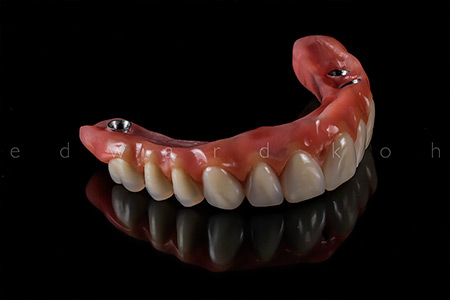 Implantes Dentários