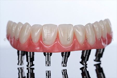 Implantes Dentários