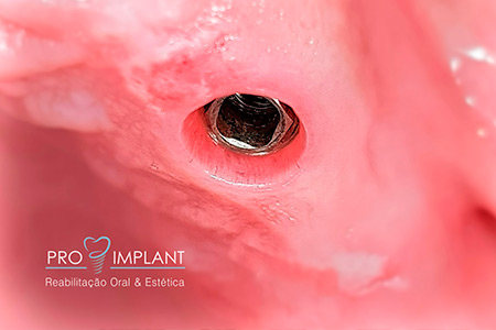Implantes Dentários