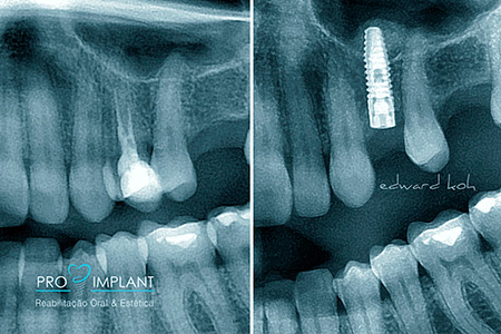 Implantes Dentários