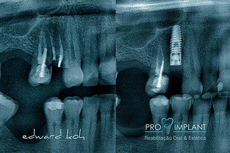 Implantes Dentários