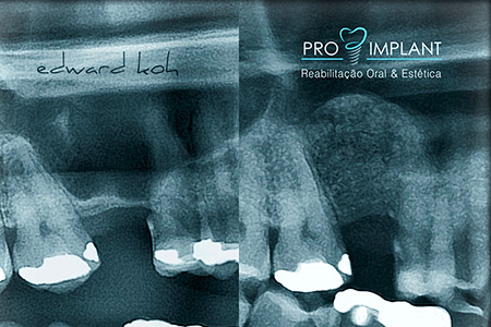 Implantes Dentários
