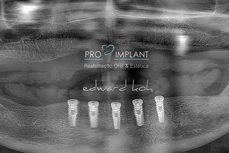 Implantes Dentários