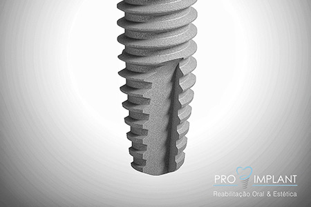 Implantes Dentários
