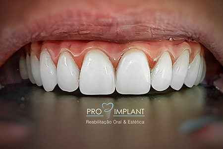 Prótese Dentária