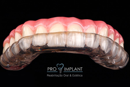 Tratamento de Disfunções de ATM